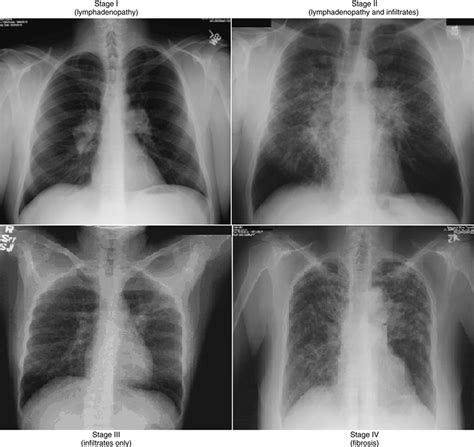 Sarcoidosis .